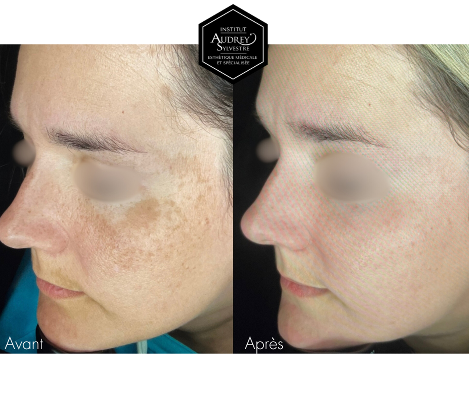 Peeling MeLine