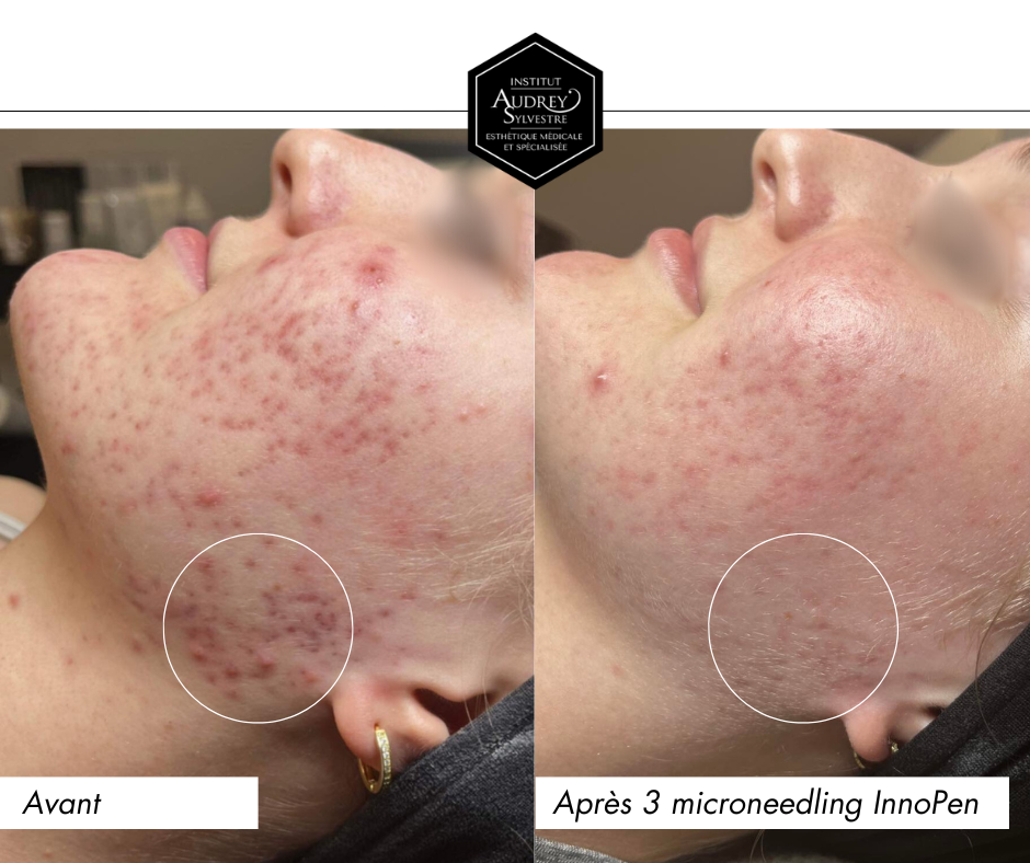 Microneedling, InnoPen