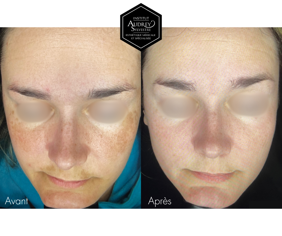 Peeling MeLine