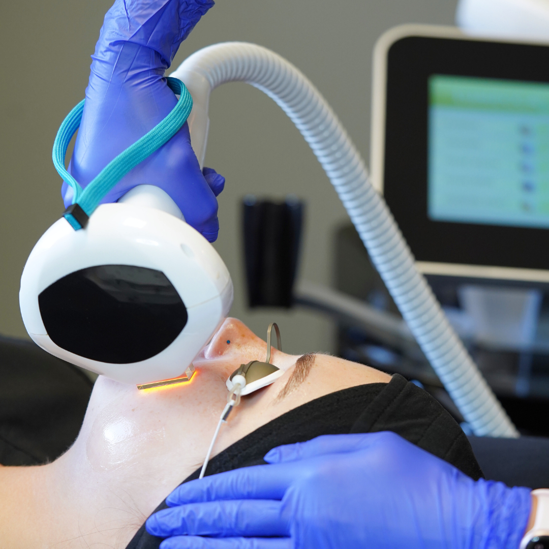 Technologie Lumecca IPL
