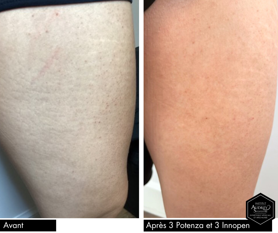 Microneedling, InnoPen