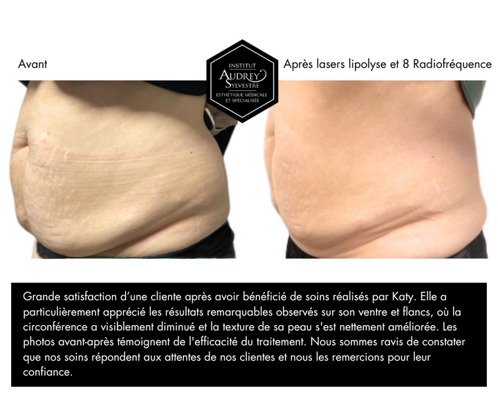 Laser lipolyse Bliss pour le corps