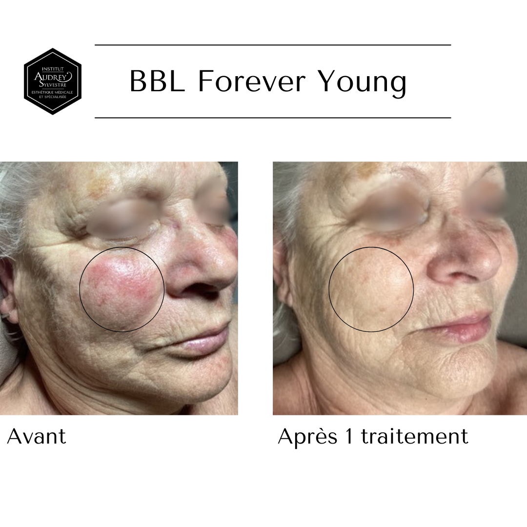 Traitement au Laser BBLs Forever Young