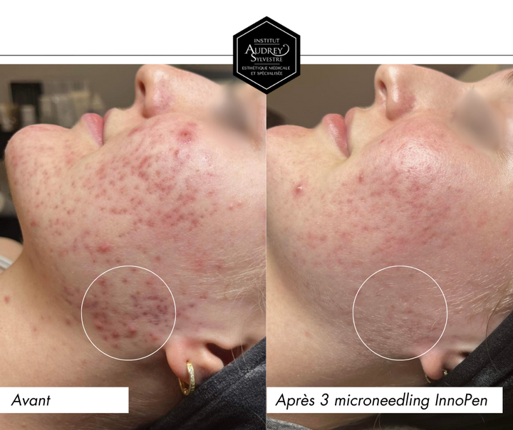 Microneedling, InnoPen