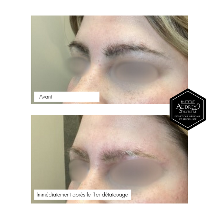 Détatouage Q-Switch