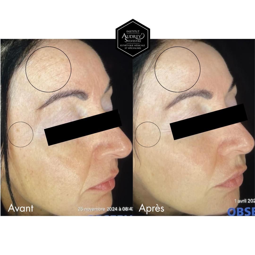 LaseMD Ultra Lutronic