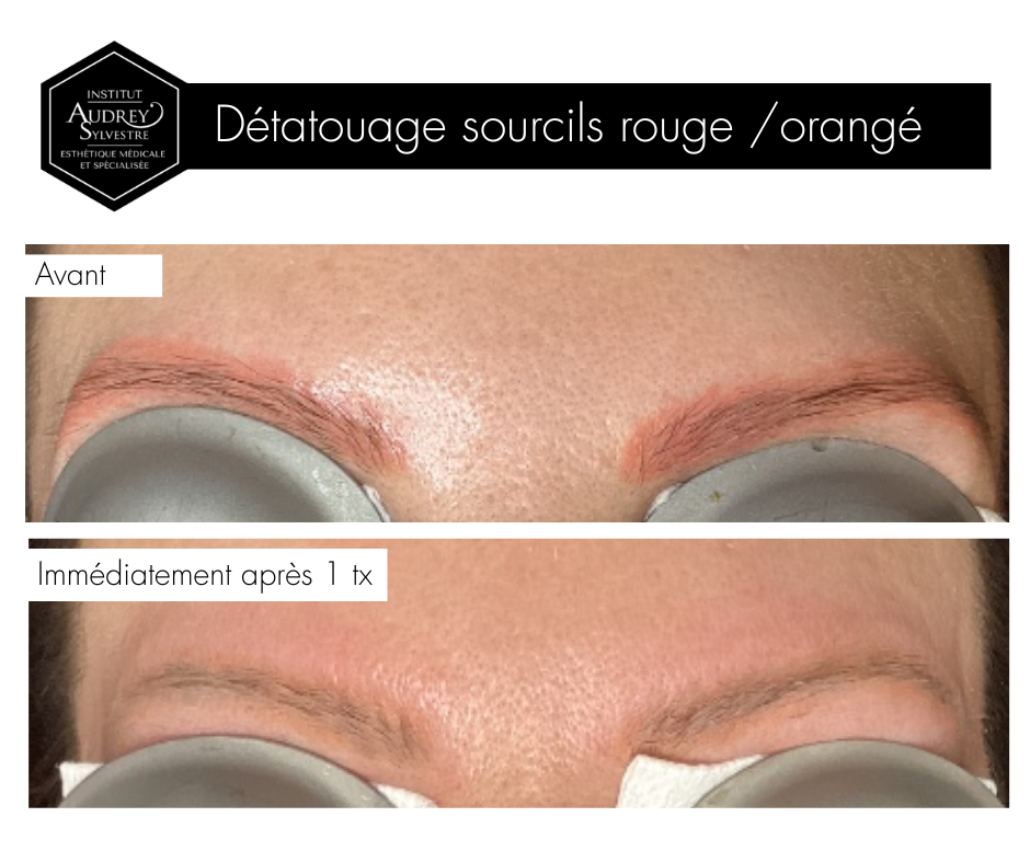 Détatouage Q-Switch