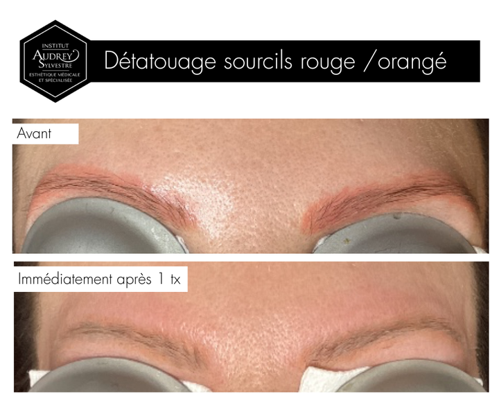 Détatouage Q-Switch