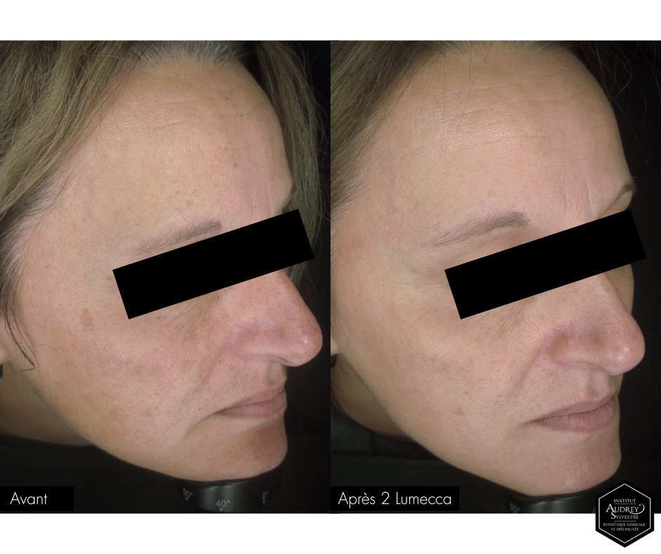 Technologie Lumecca IPL