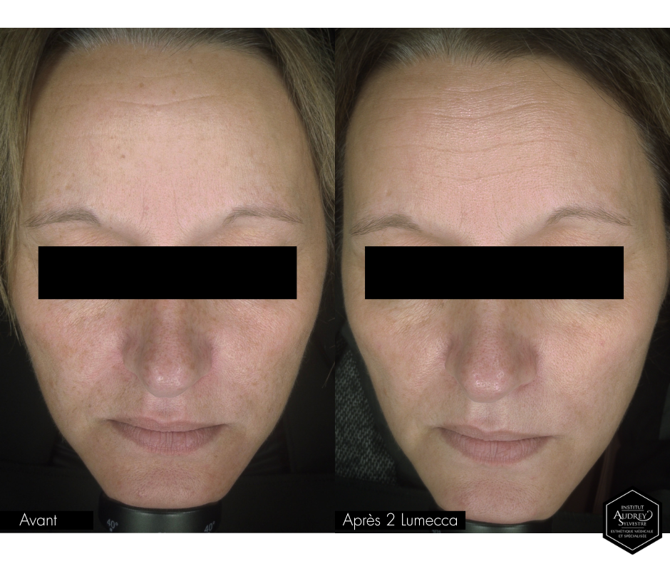 Technologie Lumecca IPL