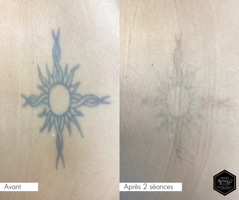 PicoSure Pro détatouage