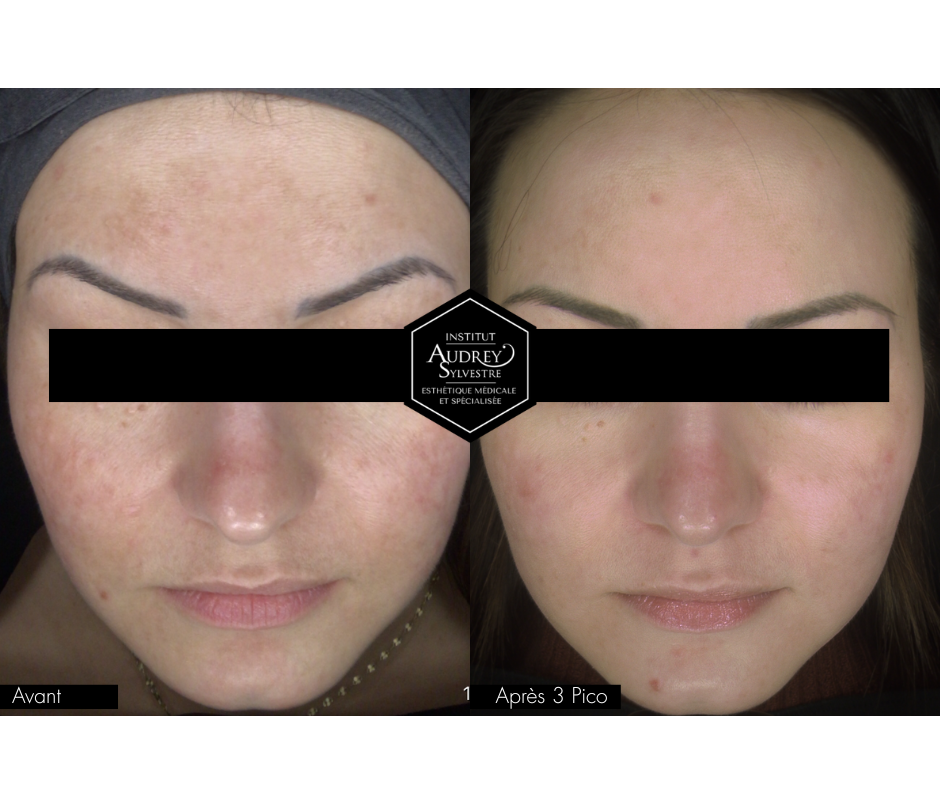 Photofacial Picosure Pro