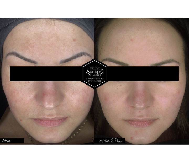 Photofacial Picosure Pro