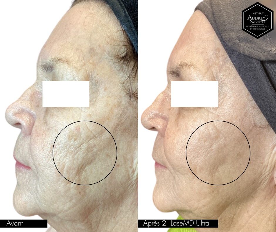 LaseMD Ultra Lutronic