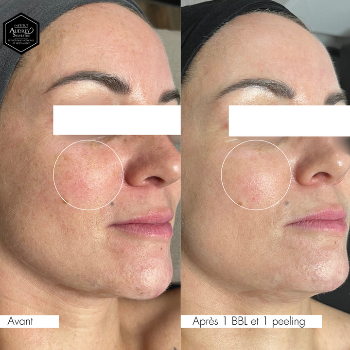 Traitement au Laser BBLs Forever Young