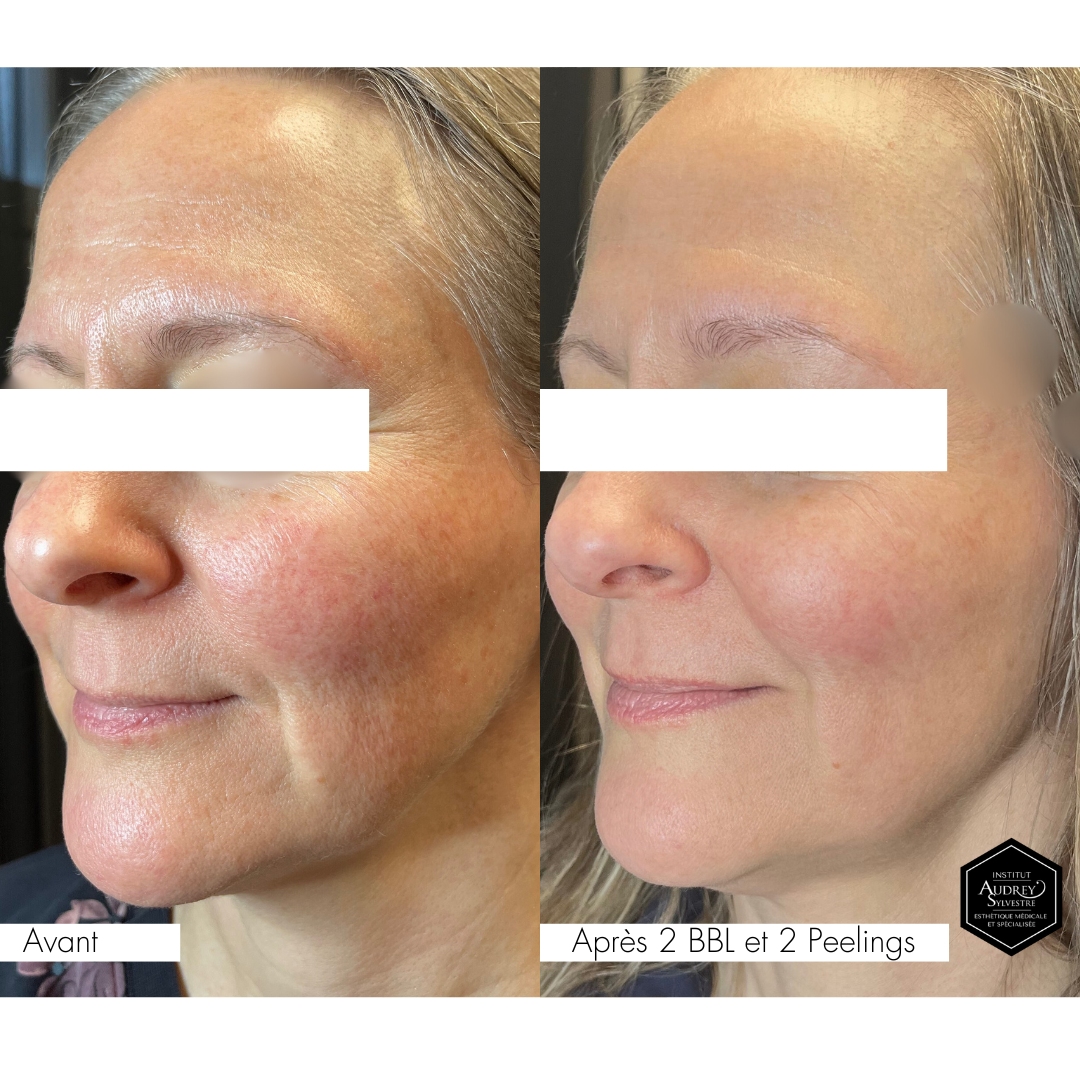 Traitement au Laser BBLs Forever Young