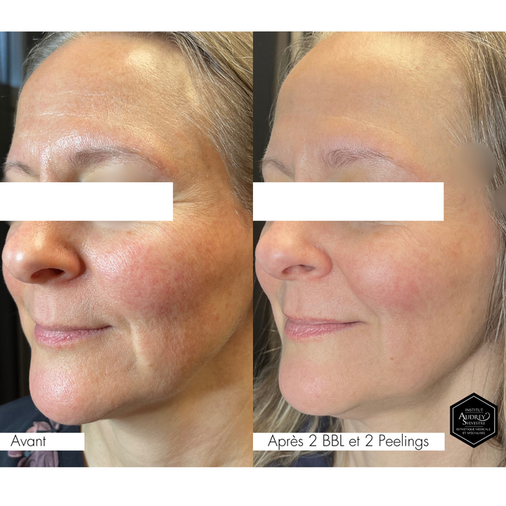 Traitement au Laser BBLs Forever Young