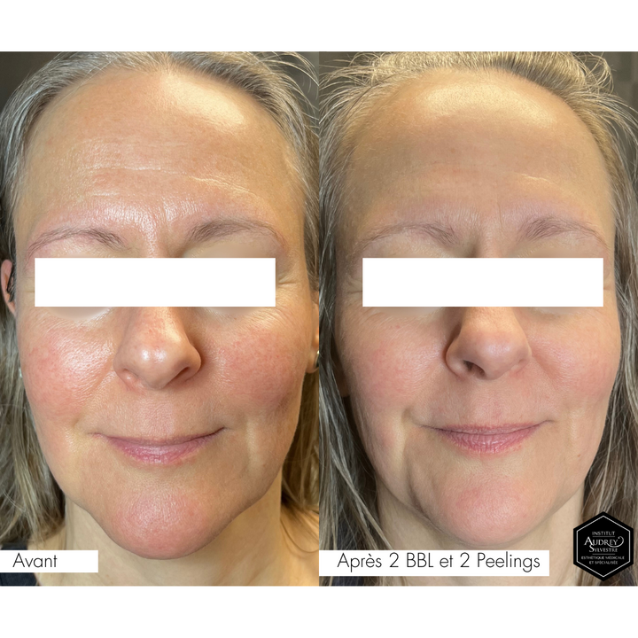 Traitement au Laser BBLs Forever Young