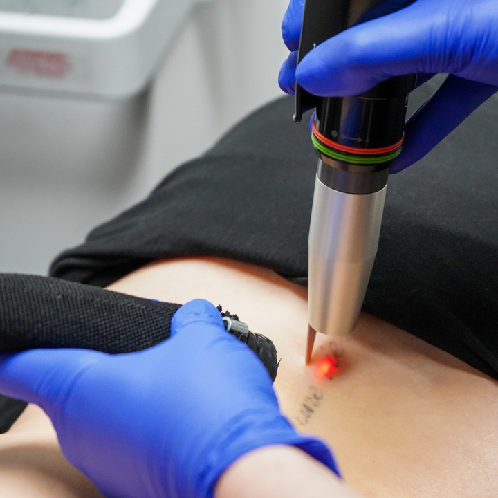 Détatouage Q-Switch