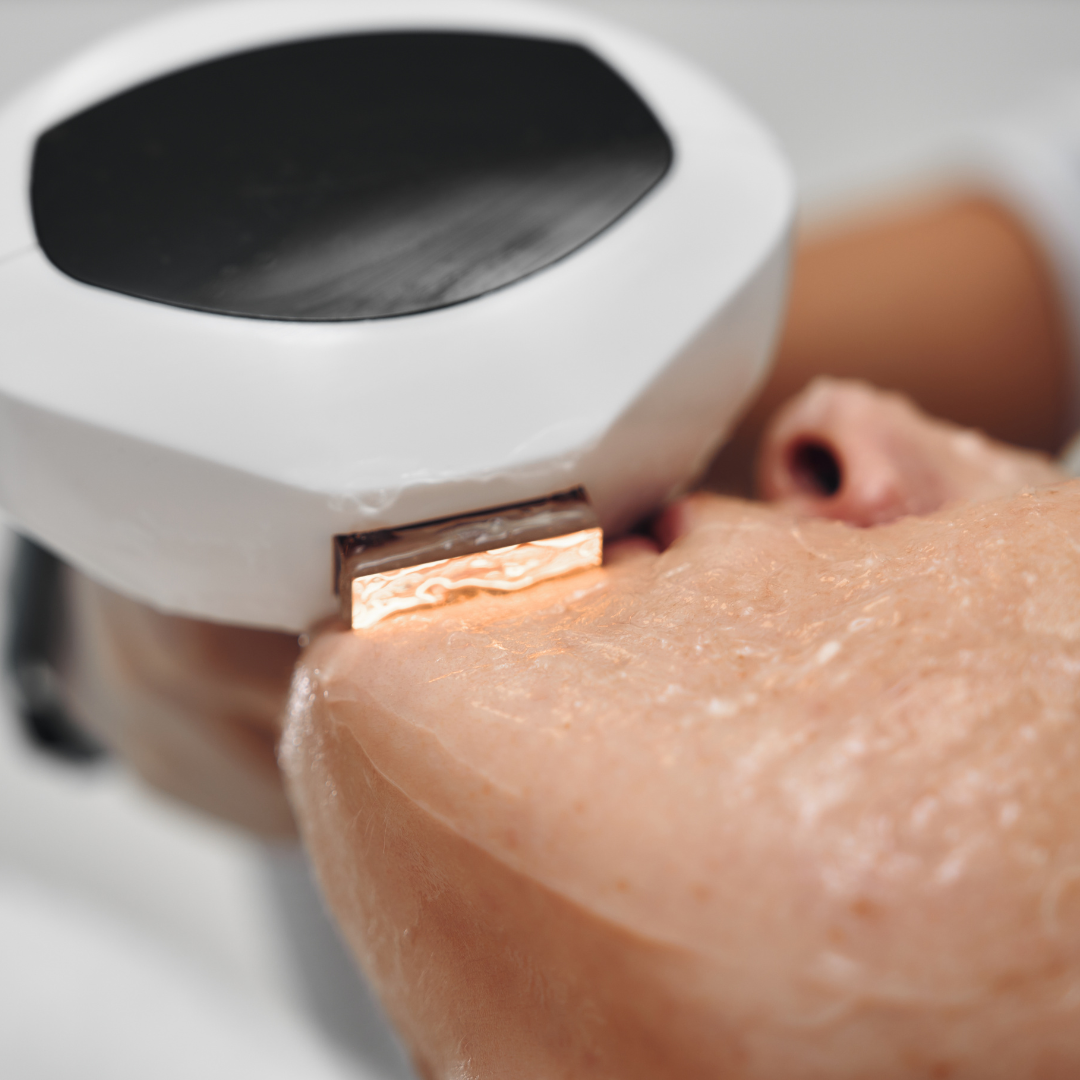 Technologie Lumecca IPL