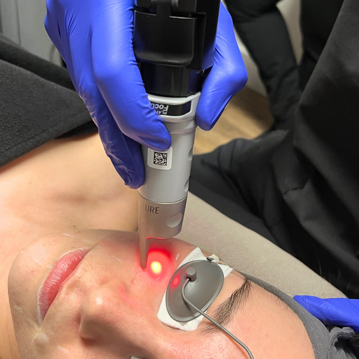 Photofacial Picosure Pro