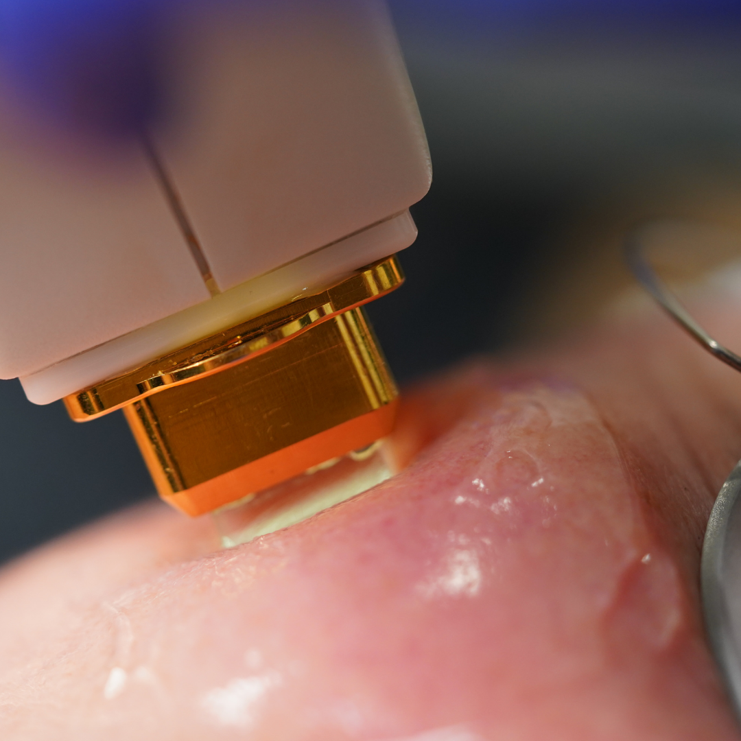 Traitement au Laser BBLs Forever Young