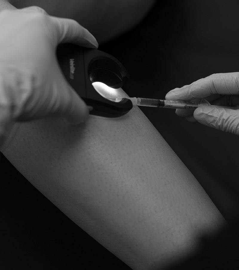 Traitement Sclérothérapie (varices)