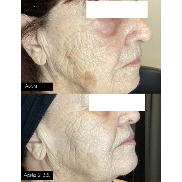 Traitement au Laser BBLs Forever Young