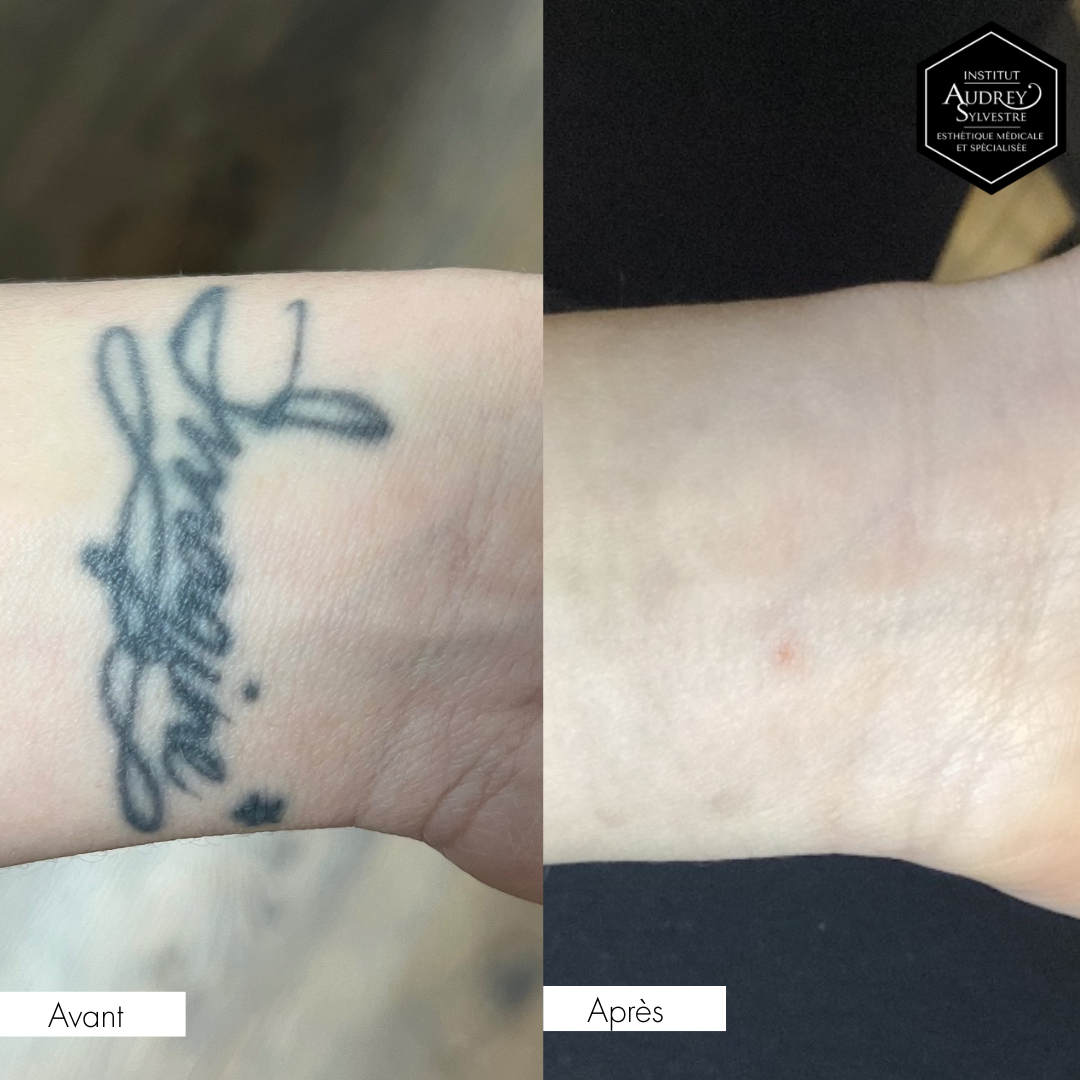 Détatouage Q-Switch