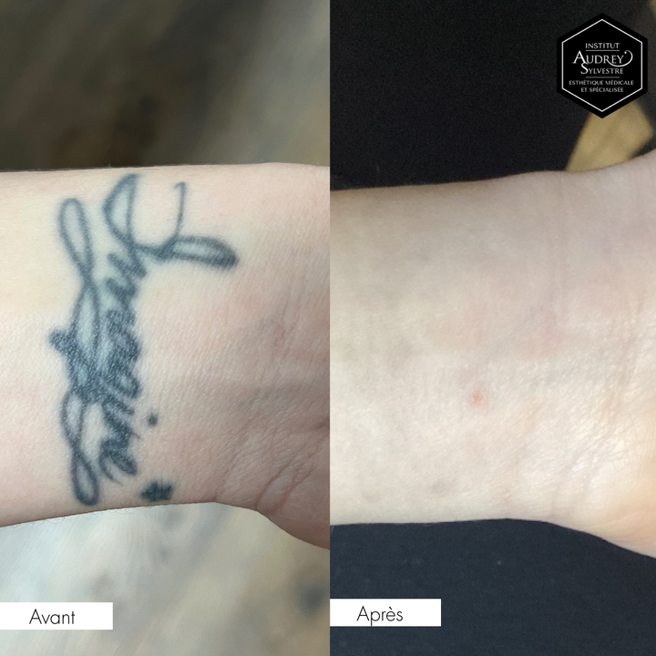 Détatouage Q-Switch