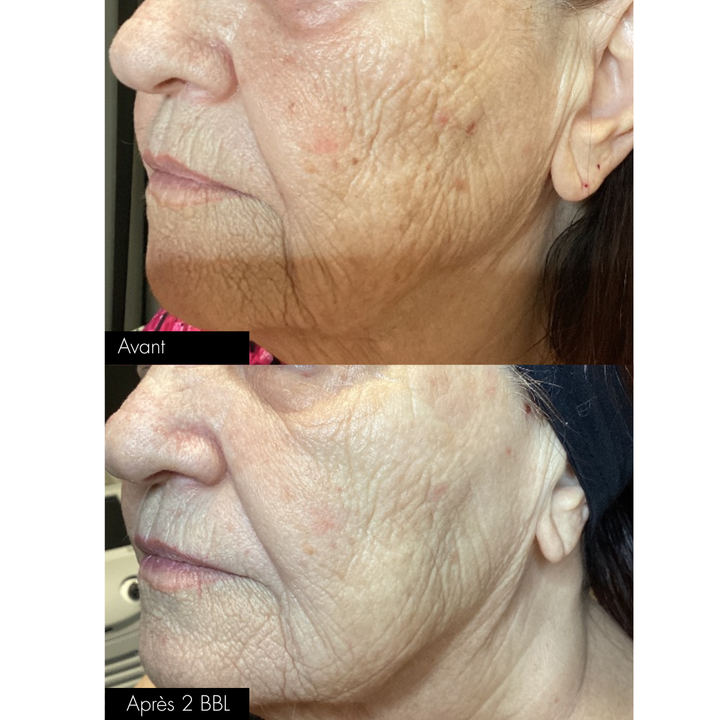Traitement au Laser BBLs Forever Young