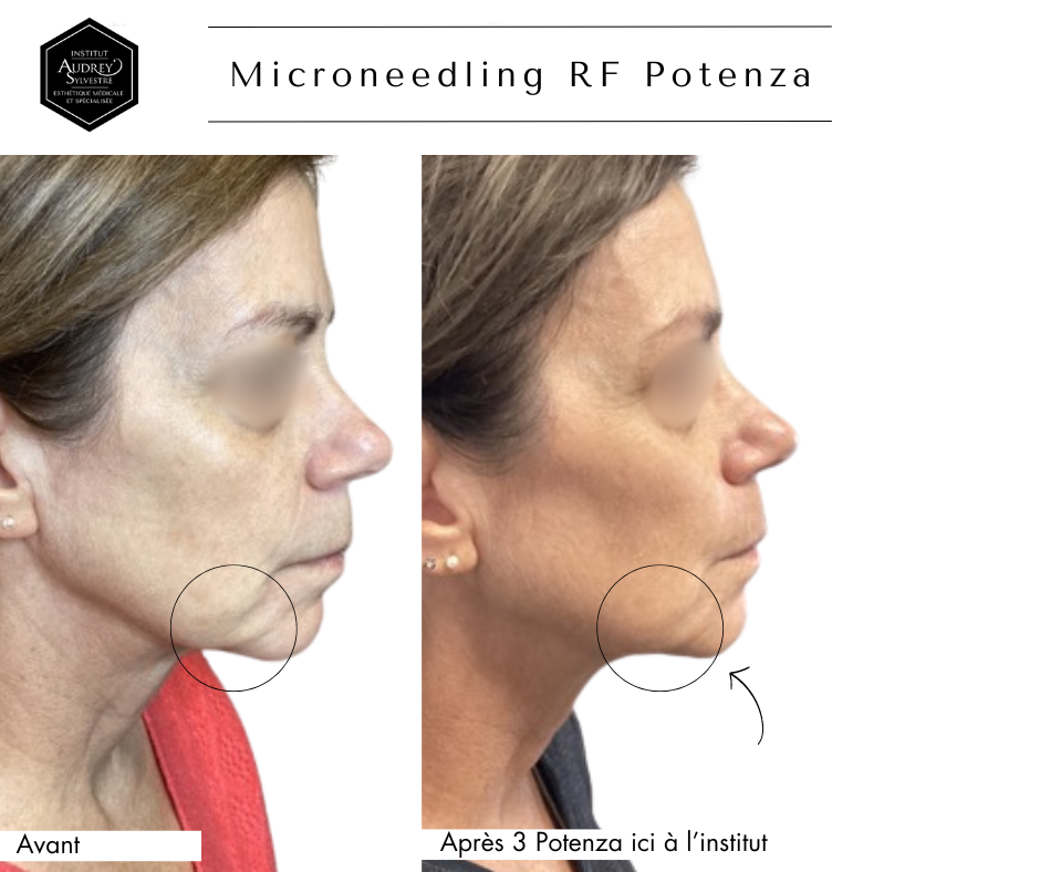 Microneedling RF Potenza
