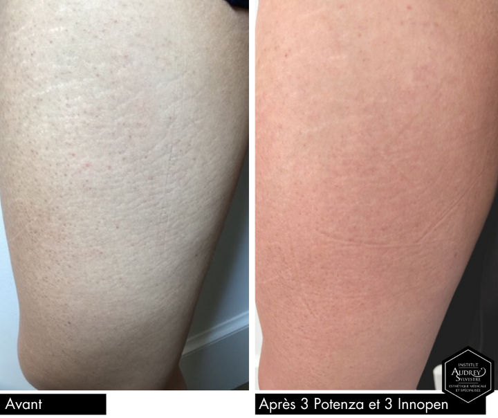 Microneedling RF Potenza