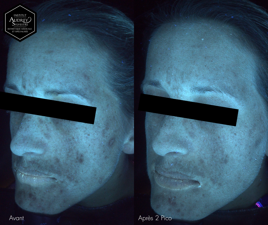 Photofacial Picosure Pro