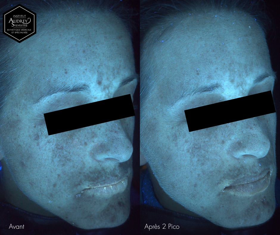 Photofacial Picosure Pro