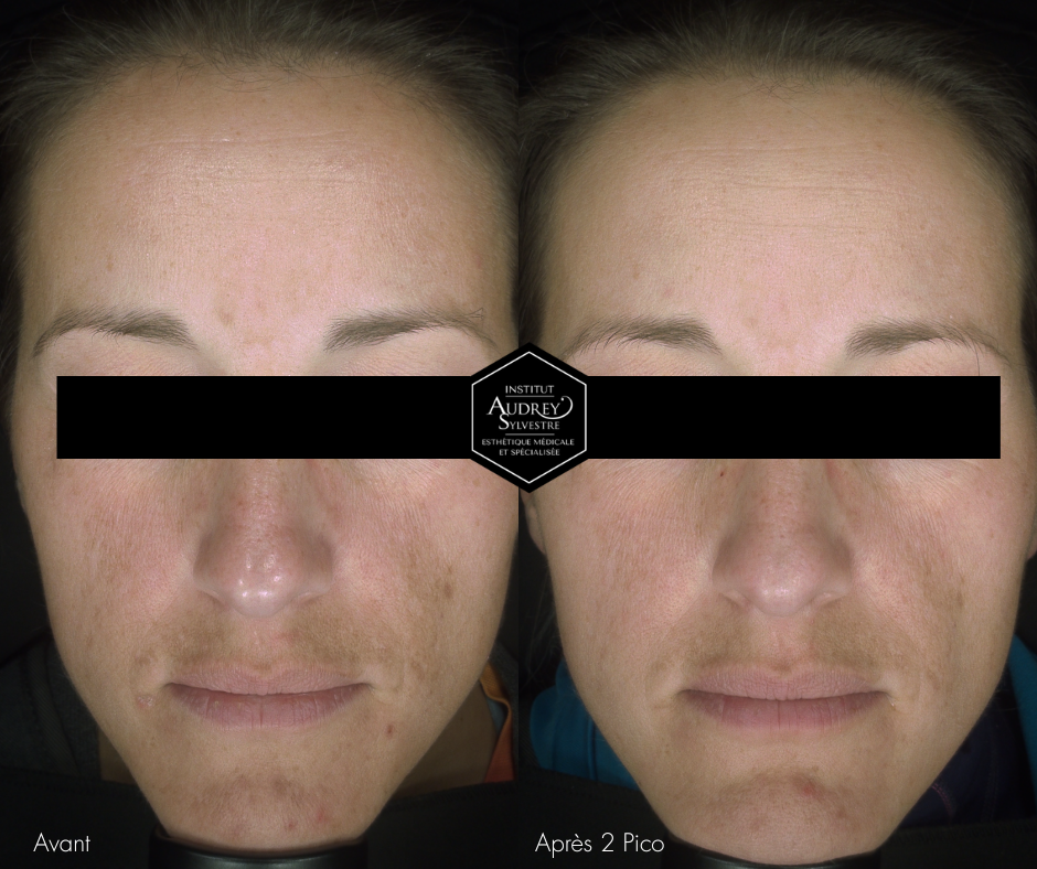 Photofacial Picosure Pro