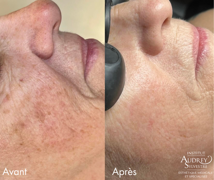 Microneedling RF Potenza