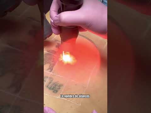 PicoSure Pro détatouage