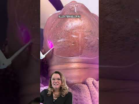 Épilation au laser (Diode, Alexandrite et YAG)