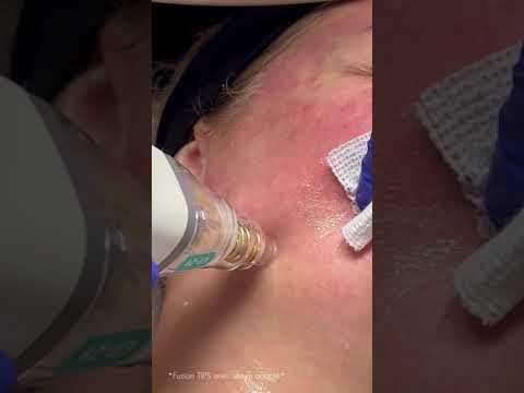 Microneedling RF Potenza