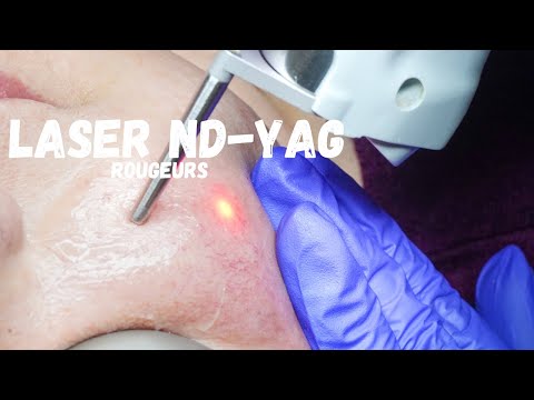 Laser pour atténuer les rougeurs