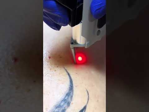 Laser pour atténuer les rougeurs