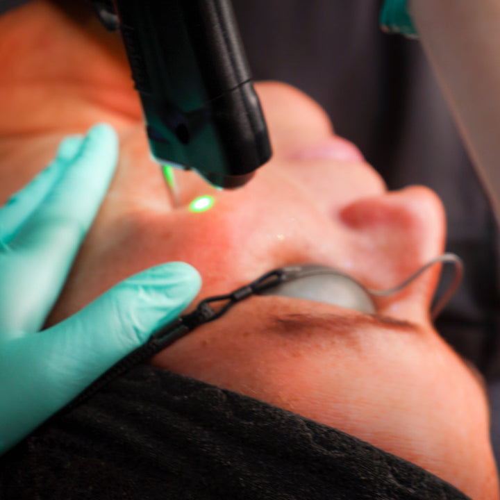 Laser ciblé pour tache  -  Alexandrite