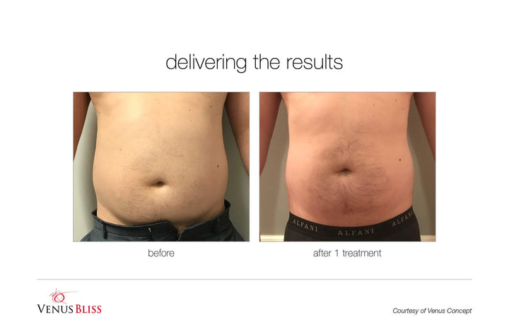 Laser lipolyse Bliss pour le corps