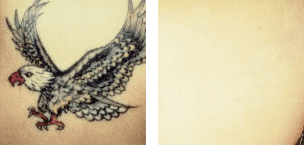 Détatouage Q-Switch