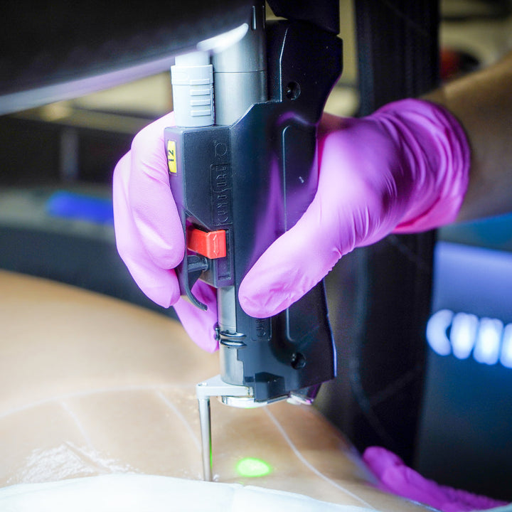 Épilation au laser (Diode, Alexandrite et YAG)