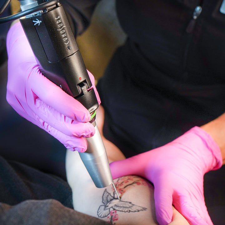 Détatouage Q-Switch