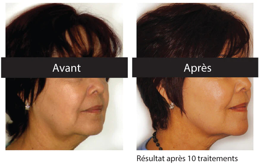 Soin lifting  visage avec Venus Freeze