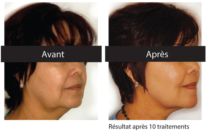 Soin lifting  visage avec Venus Freeze